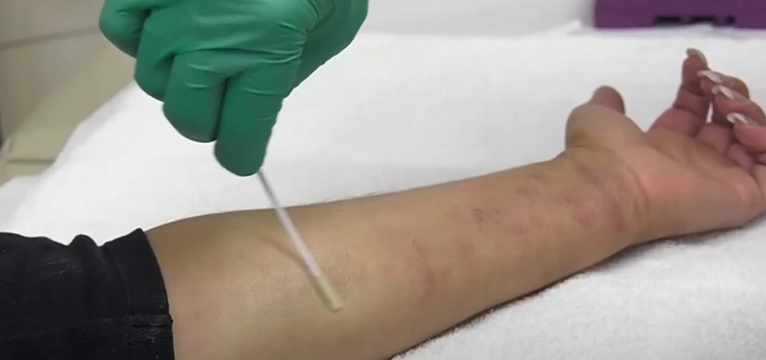 Egzama Nasıl Tedavi Edilir?