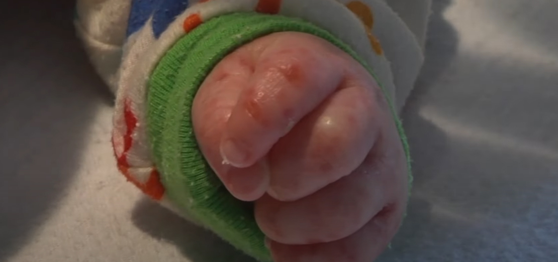 Kaç Çeşit Egzama Vardır?