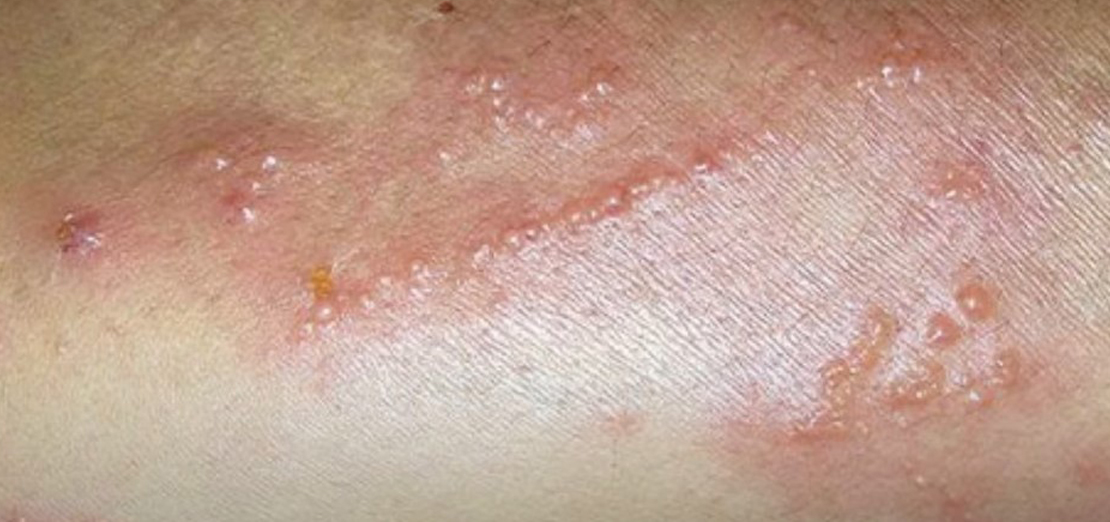 Egzamanın Belirtileri Nelerdir?