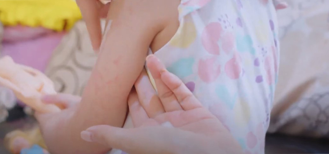 Egzama Vücudun Neresinde Görülür?