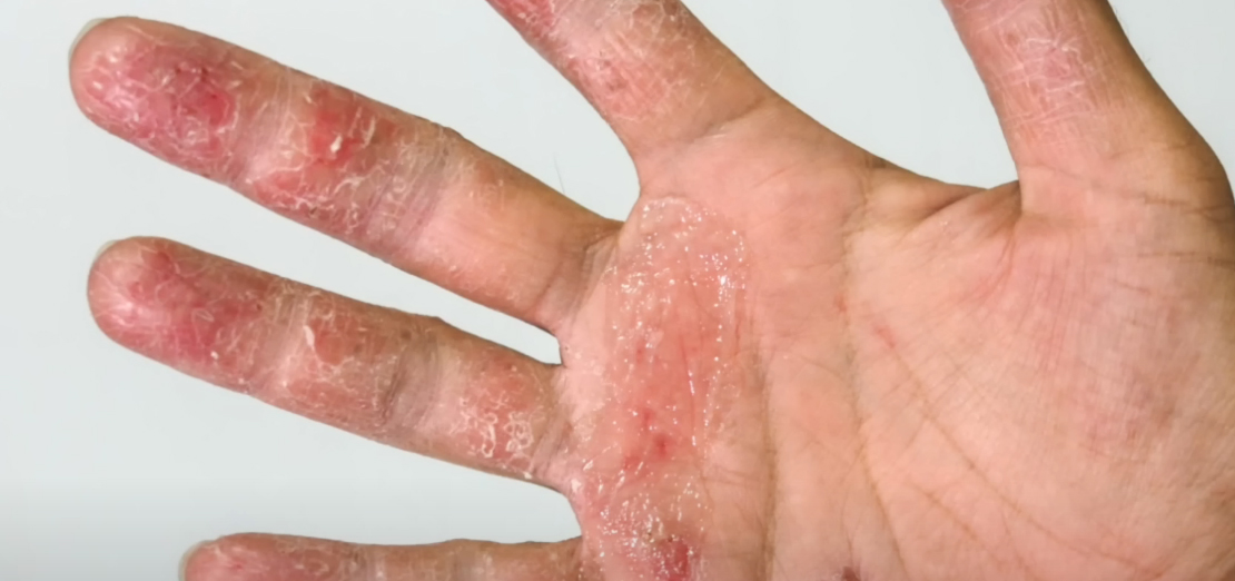 El Egzamasının Sebepleri Nelerdir?