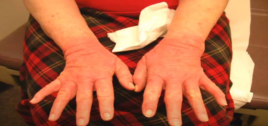 El Egzaması Tedavisi Nasıl Yapılır?